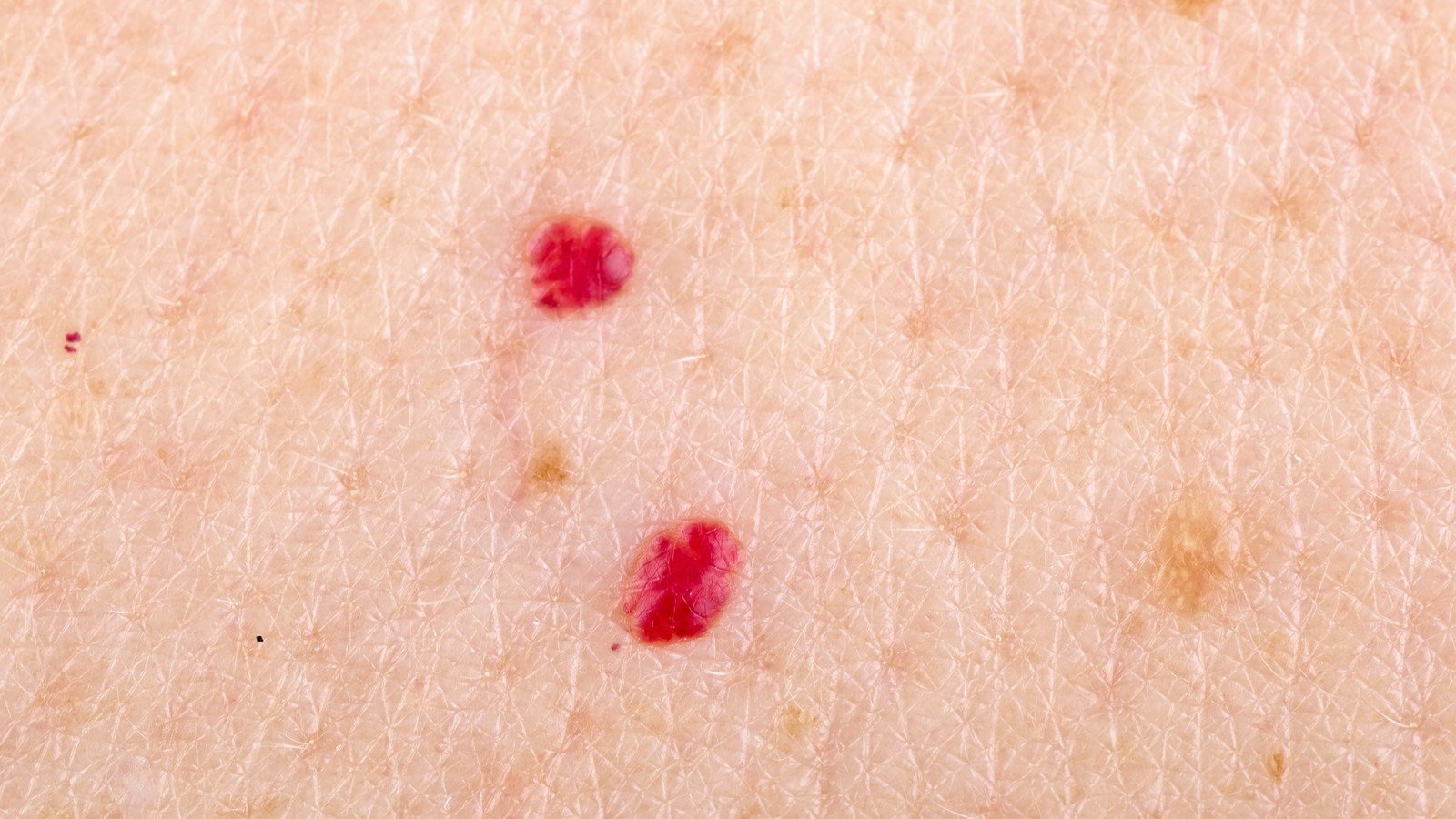 This is why you have red marks on your skin