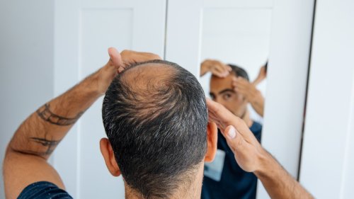 Good2Know: Study Shows Promise in Fighting Age-Related Baldness