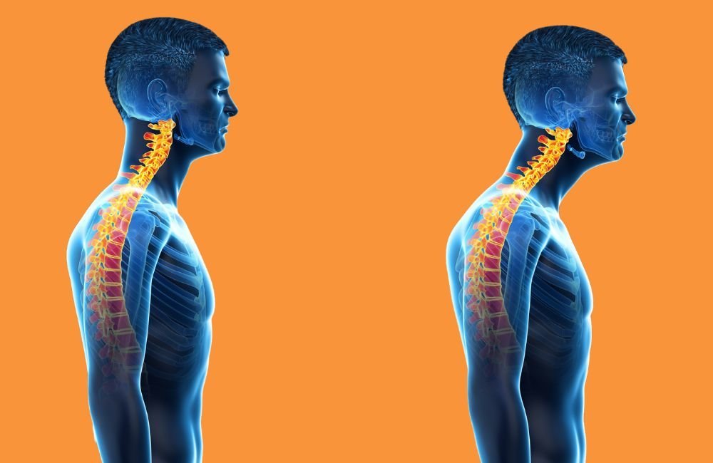 Forward Head Posture is Ruining Your Health—Here’s How to Fix It Fast