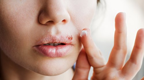 Do This If You Have A Cold Sore