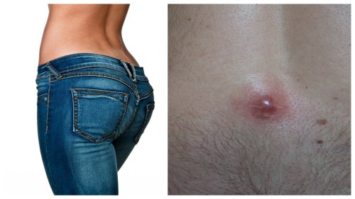 If You Find A Pimple At The Top Of Your Butt Crack It Might Be A Pilonidal Cyst