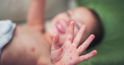 Everything You Should Know About Hand, Foot, and Mouth Disease