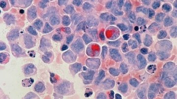 Scientists Create New Drug Therapy For Acute Myeloid Leukemia