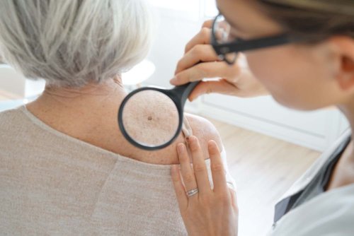 Signs of Abnormal Moles and When They Should Be Removed