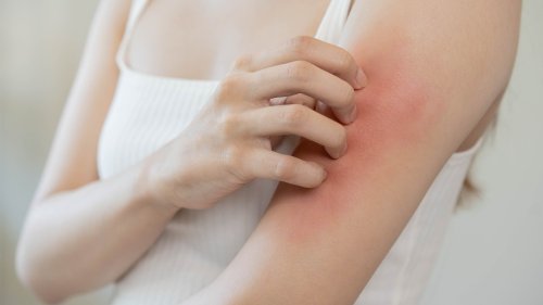 The 5 Best Types Of Food To Eat For Itchy Skin  