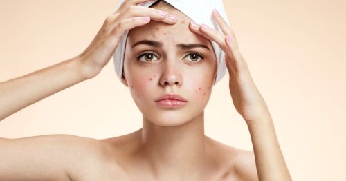 Acne Treatments & Prevention