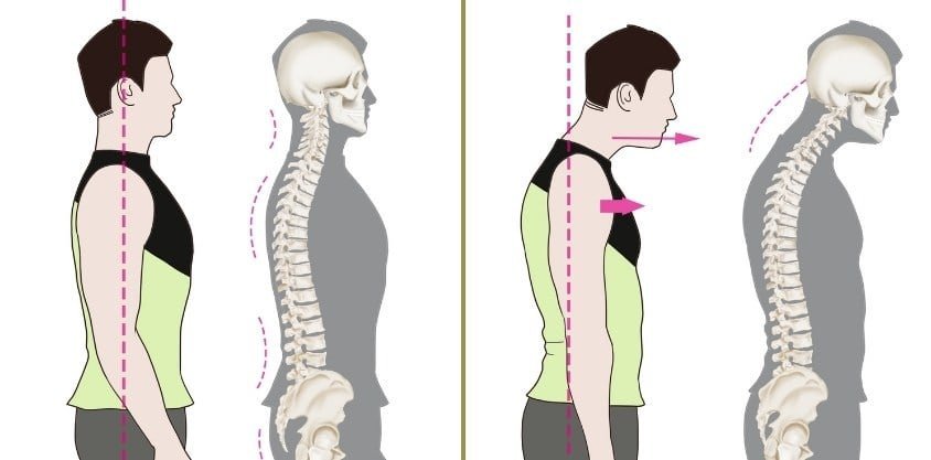 3 Simple Exercises to Fix Forward Head Posture