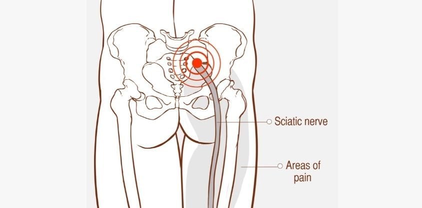 Do These Sciatica Stretches To Get Rid of Hip and Lower Back Pain