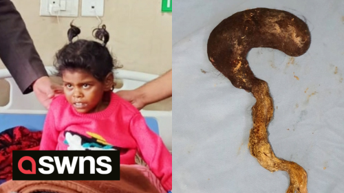 Surgeons in India extract huge hair mass from little girl's stomach
