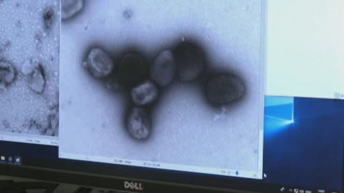 Health officials urge calm as more monkeypox cases emerge in Canada