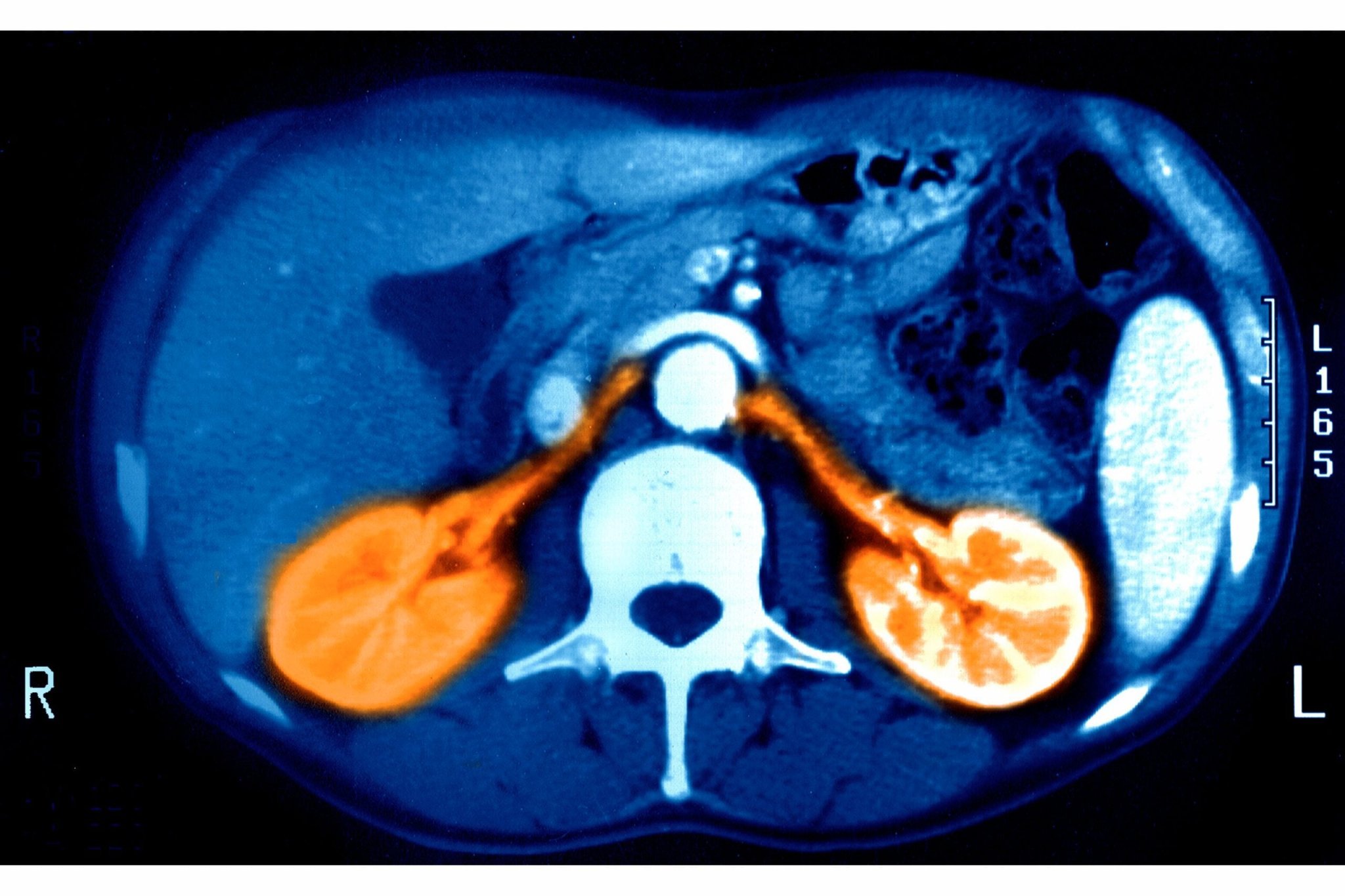 Here's How Much Water You Should Drink to Help Your Kidneys