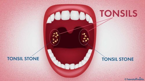 What in the World Are Tonsil Stones? — Plus More on Oral Health