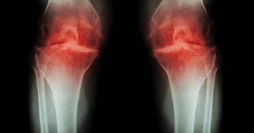 Popular anti-inflammatories linked to worse osteoarthritis progression