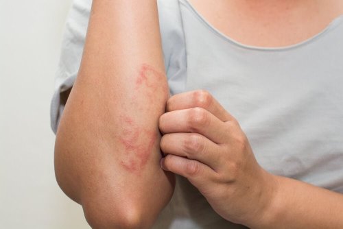 What’s That Rash? How to ID 14 of the Most Common
