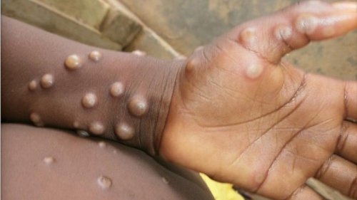 Monkeypox: What we know about the smallpox-like virus spreading in Europe, the US and Canada