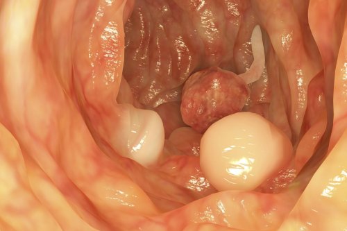How to Tell If You Have Colon Polyps