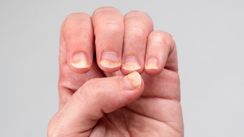 If This Is Happening To Your Nails It May Be An Autoimmune Disease 