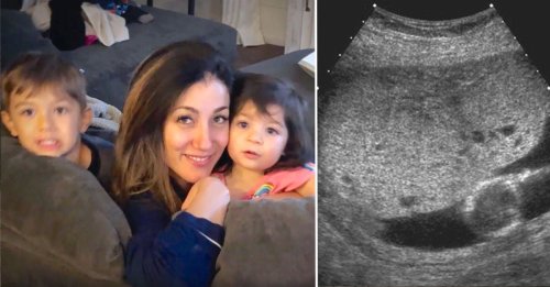 Pregnant Woman Gets Ultrasound, It Turned Into Rare Cancer