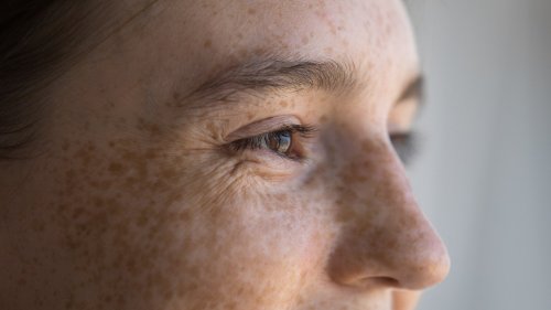 Sun Spots Vs. Freckles: How To Know The Difference And Why It Matters  