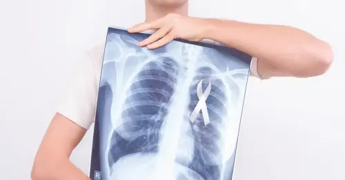 Everything You Should Know About Lung Cancer