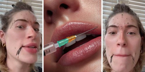 People Are Injecting Filler And Botox At Home. Is It Safe?