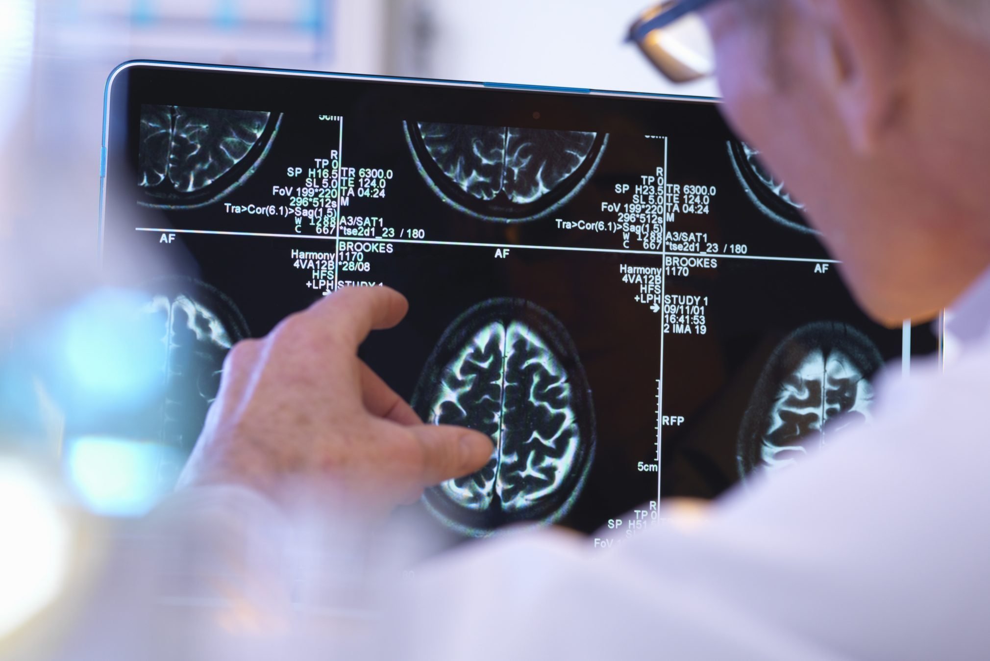 This 3- Minute Quiz May Reveal Your Alzheimer's Risk