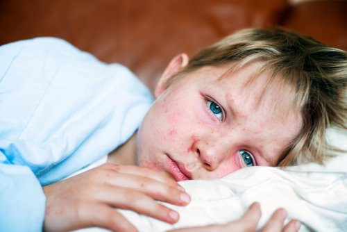 Expert Doctors: Measles Has Now Been Identified in 6 US States