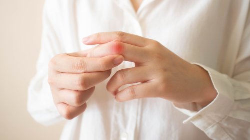 How To Treat Burned Fingers
