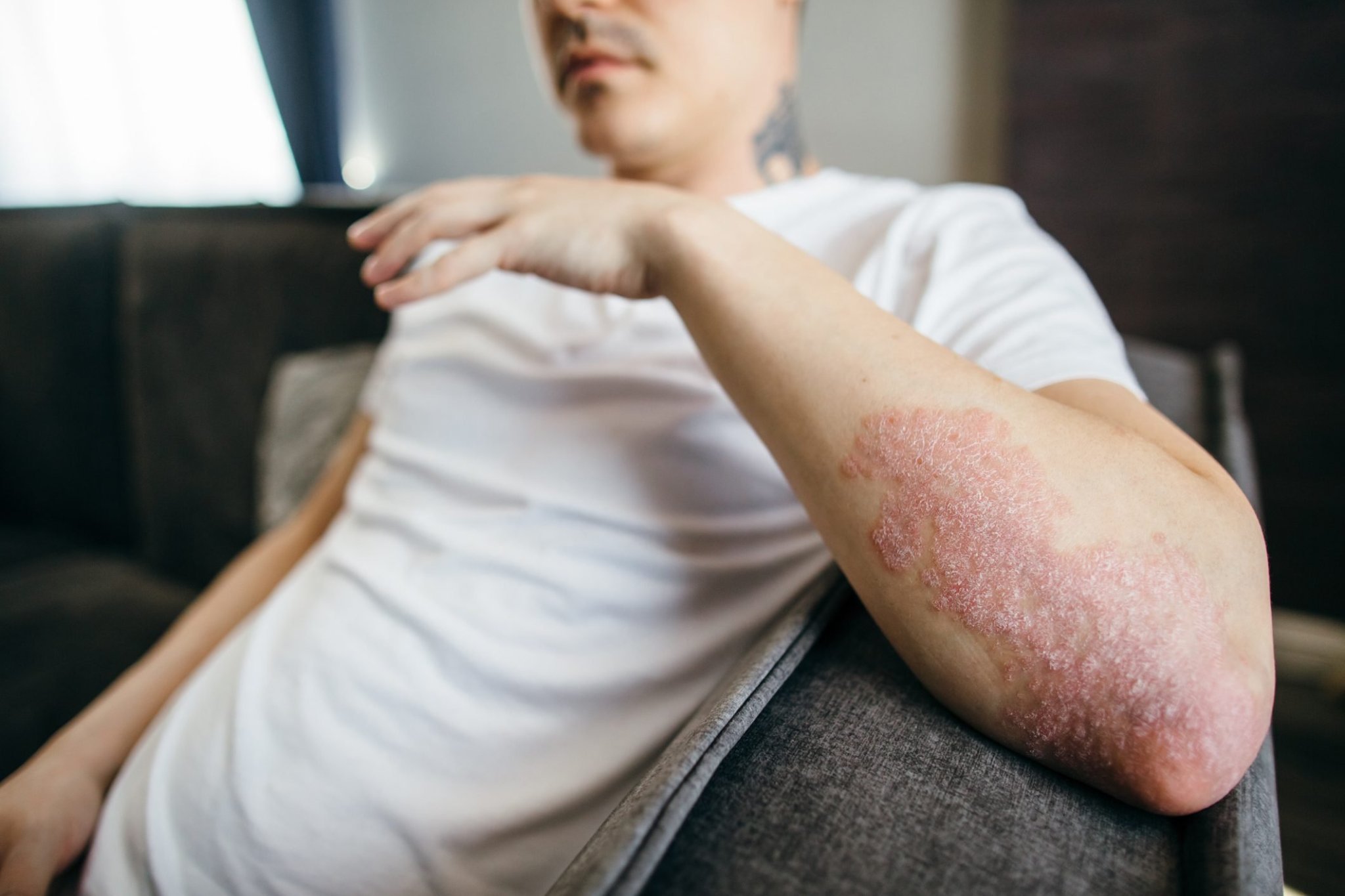 Monkeypox, Acne and Eczema: Know This About Your Risk