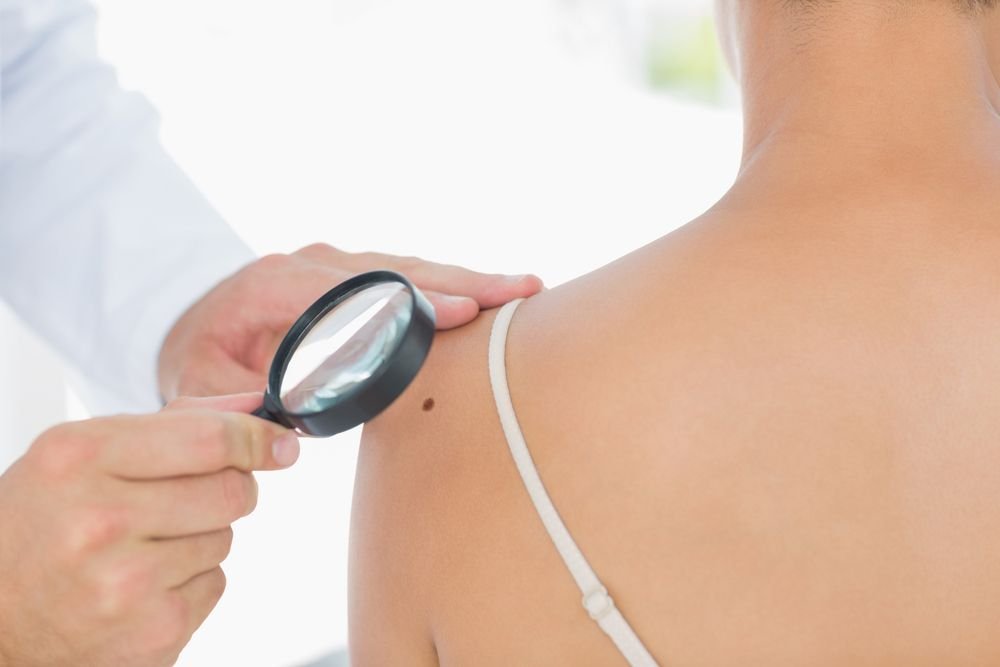 Signs and Symptoms of Melanoma — Plus More On Skin Cancer