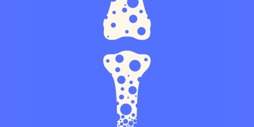 Are You at Risk for Osteoporosis?