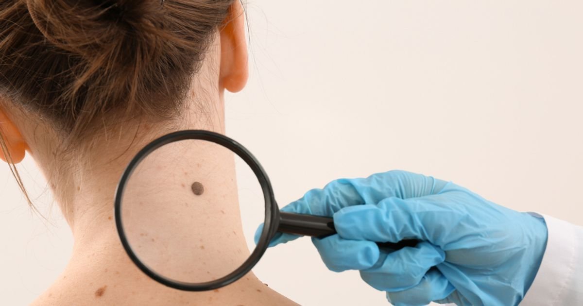 Common Types of Skin Cancer — Plus  Risk Factors, Symptoms and Foods