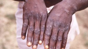 Cases of Monkeypox Spreading Around the World Raise Public Health Alarm