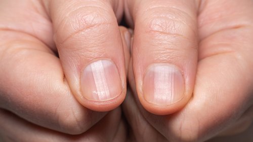 Fingernail Ridges: Causes And Treatments For Vertical And Horizontal Nail Lines 