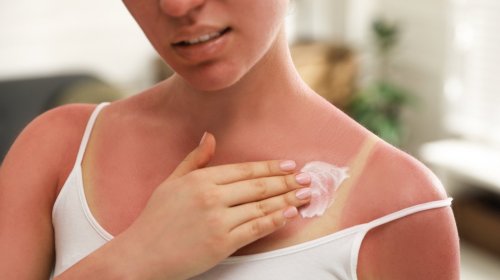 What Happens To Your Body When You Get Sunburned More Than Five Times