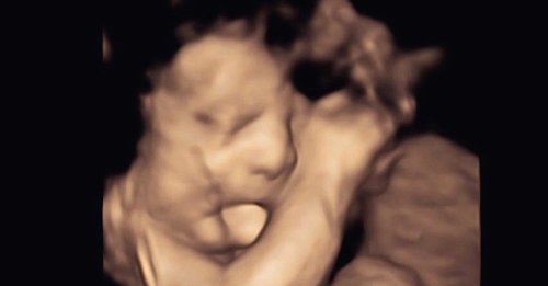 Doctors Think Unborn Baby Is ‘Just Being Cute’ Until They See His Tougue