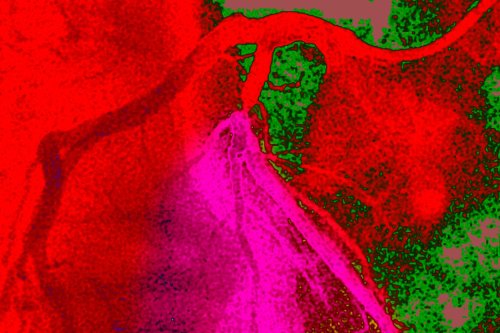 “Here’s How I Knew I Had a Heart Blockage”
