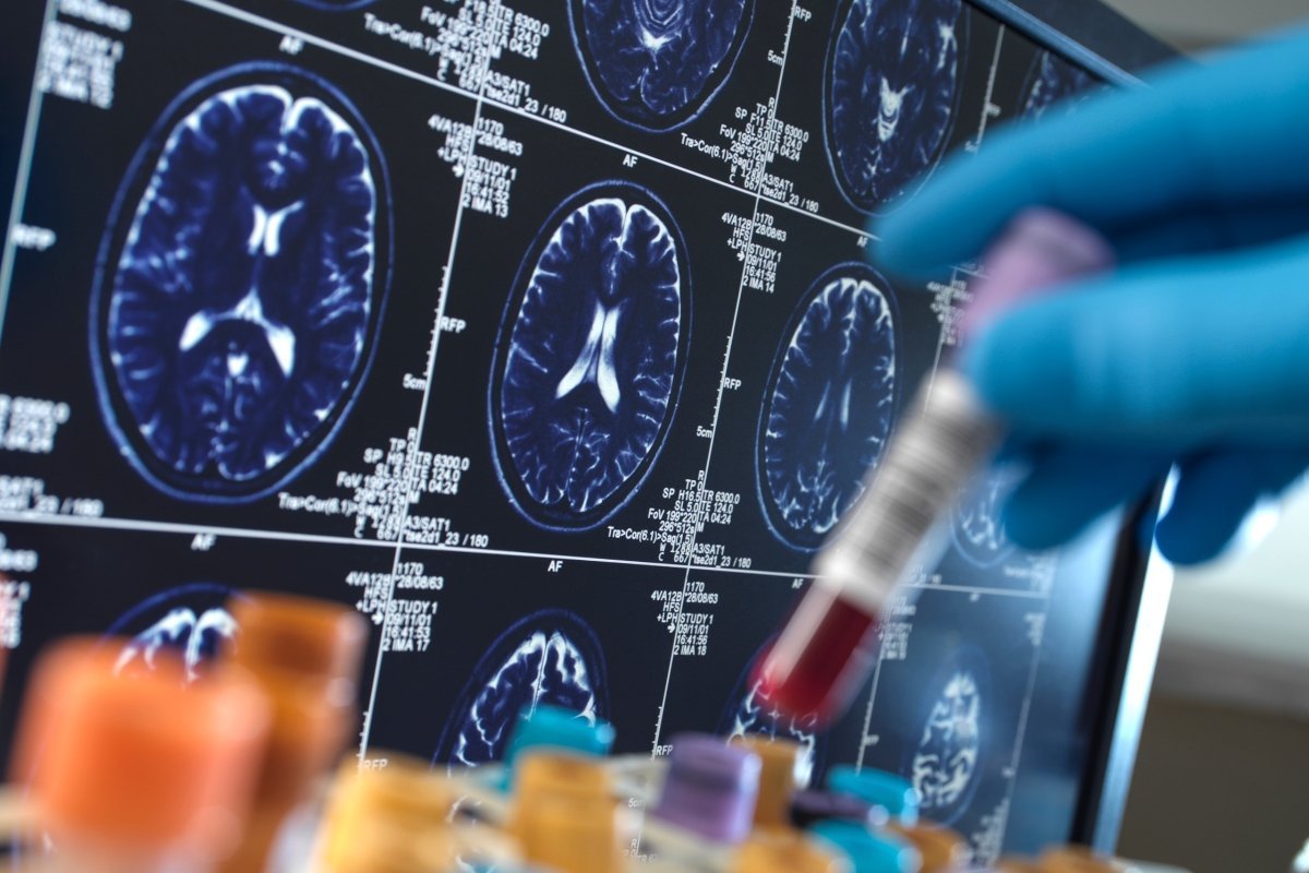 Inside the promising new drug that could prevent Alzheimer’s