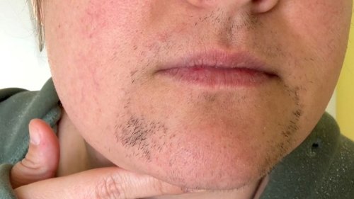 "I grew facial hair aged 13 - and spent $10k trying to remove it"