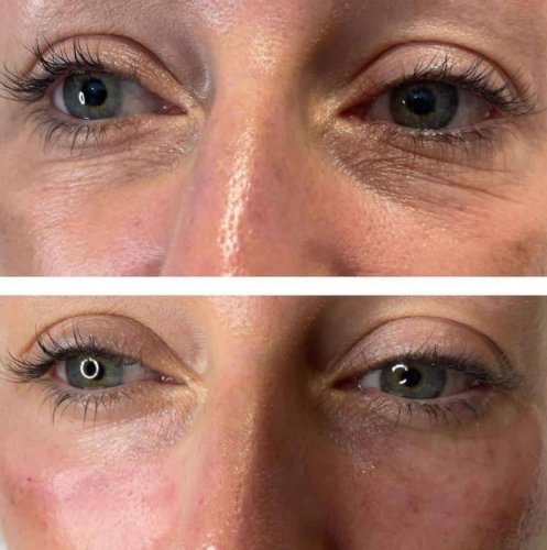 8 MOST EXPENSIVE NON-SURGICAL FACE TREATMENTS FOR MEN AND WOMEN
