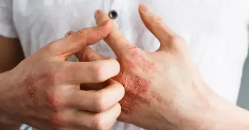 Everything You Should Know About Eczema