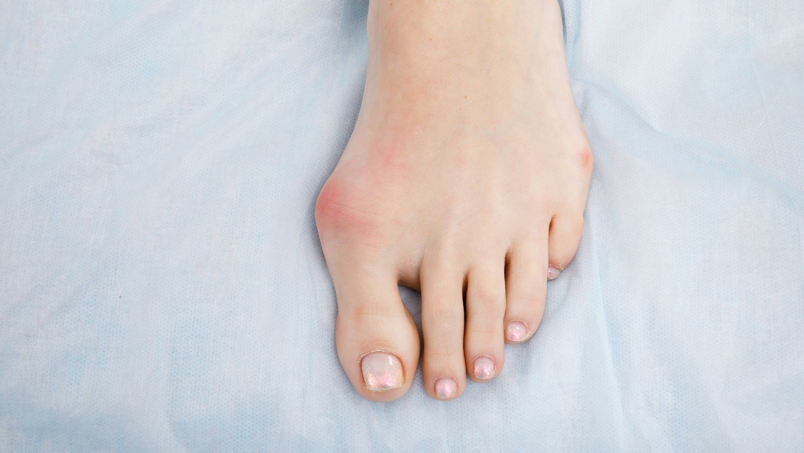 Ways To Treat Bunions At Home So You Don't Need Surgery 