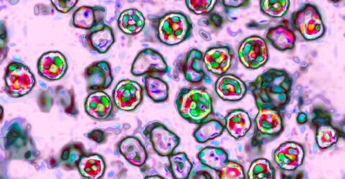 What to Know About Measles