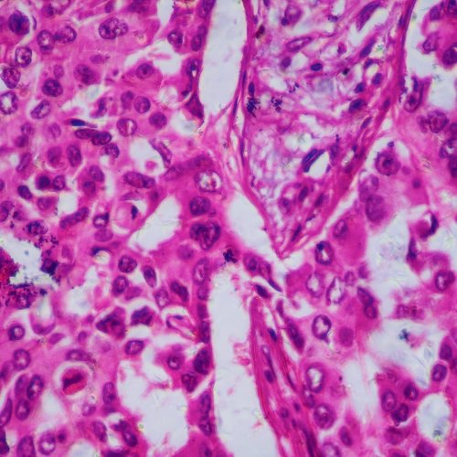 What Is Inflammatory Breast Cancer? 