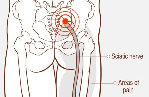 5 Stretches That Will Help to Vanquish Your Sciatica Pain