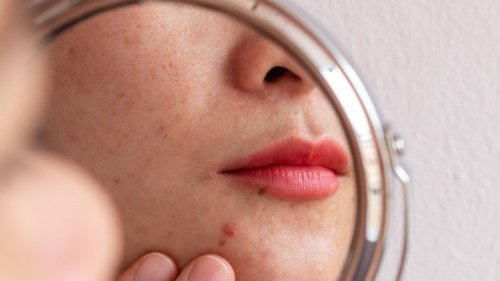 Everything You Wanted To Know About Acne