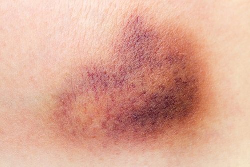 The Real Reason You Bruise So Easily