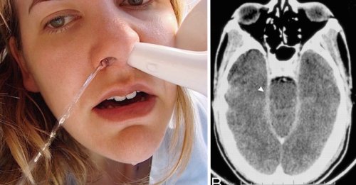 Seattle Woman Dies After Neti Pot Mistake, Doctors Warn