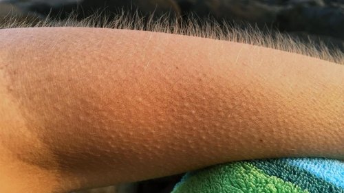 Why Do Certain Experiences Give Us Goosebumps?