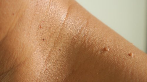 The Best Way To Get Rid Of Skin Tags